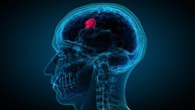 Perjuangan Seorang Wanita Menghadapi 10 Tumor Otak: Dari Kesemutan Hingga Diagnosa Berat