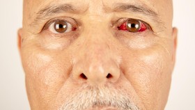 Diabetes dan Kesehatan Mata: Ancaman Serius Terhadap Kebutaan