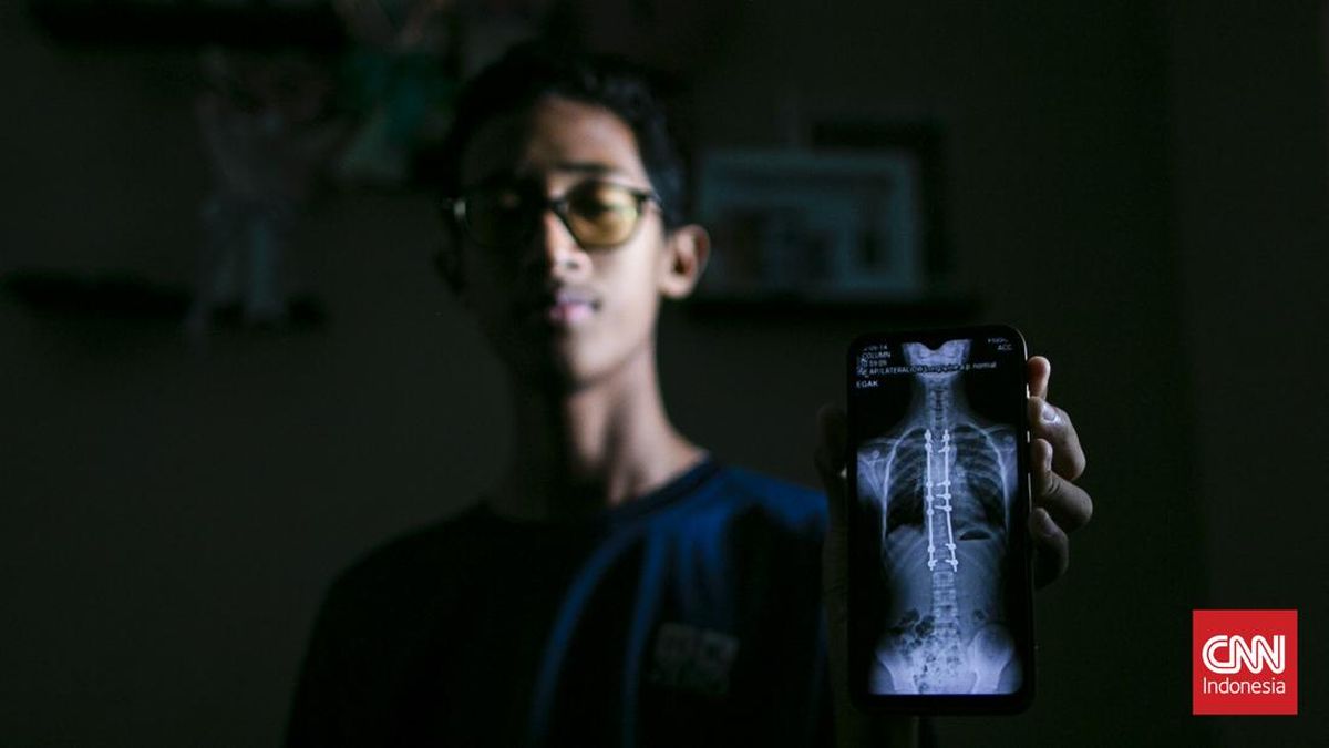 Perjuangan Refan Melawan Skoliosis dengan Bantuan Implan Titanium