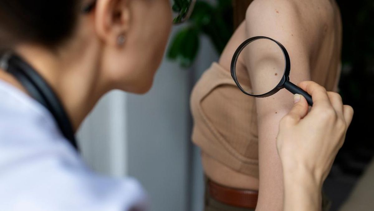 Mengenal Gejala Awal Melanoma, Kanker Kulit yang Paling Mematikan