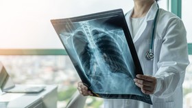 PET-CT Scan: Teknologi Canggih untuk Deteksi Aktivitas Sel Kanker yang Akurat