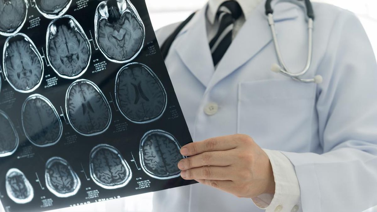 Perhatian, Penelitian Mengungkap Golongan Darah Tertentu Meningkatkan Risiko Stroke